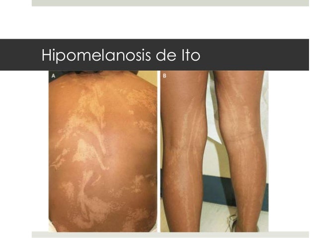 hipomelanosis de ito